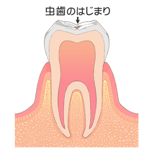 初期むし歯(C0)
