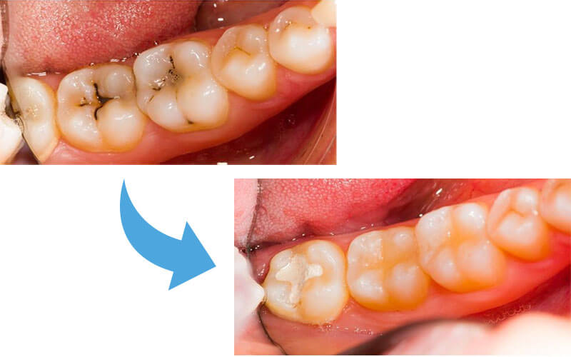 コンポジットレジン