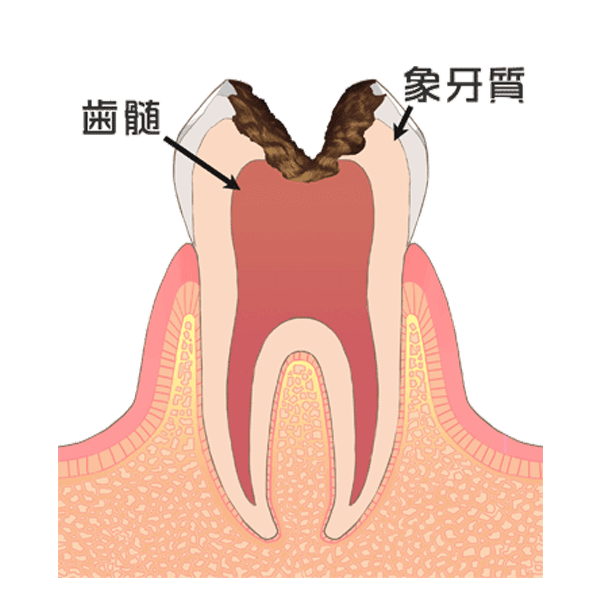 さらに進行したむし歯(主にC3)
