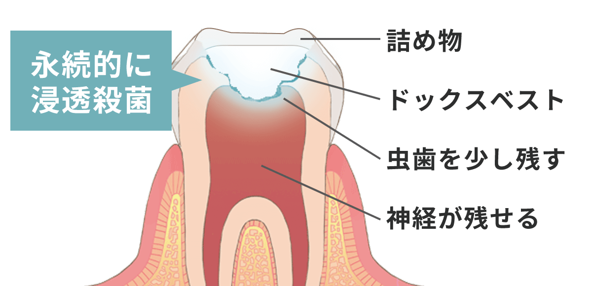 ドックスベストの仕組み