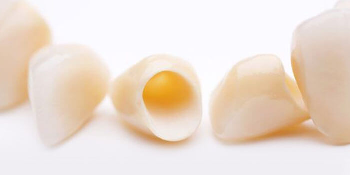 オールセラミッククラウン