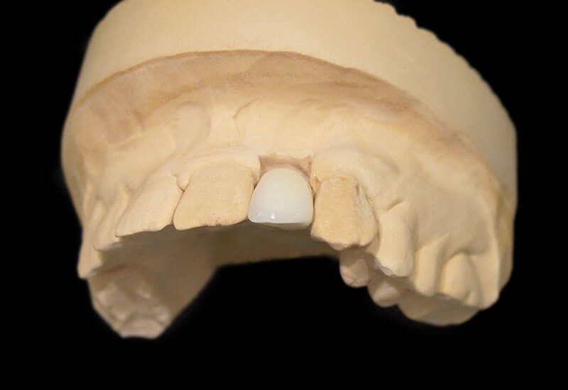 補綴（詰め物・被せ物）