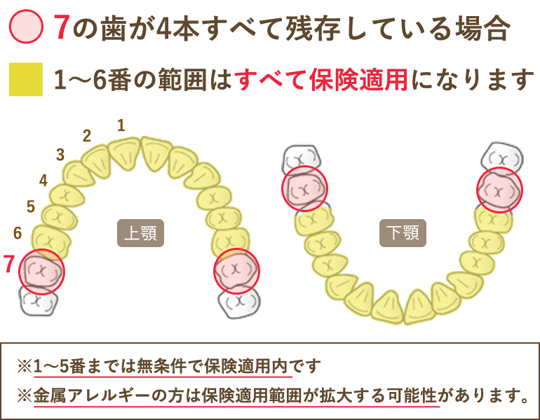 CAD/CAM冠の保険適用範囲