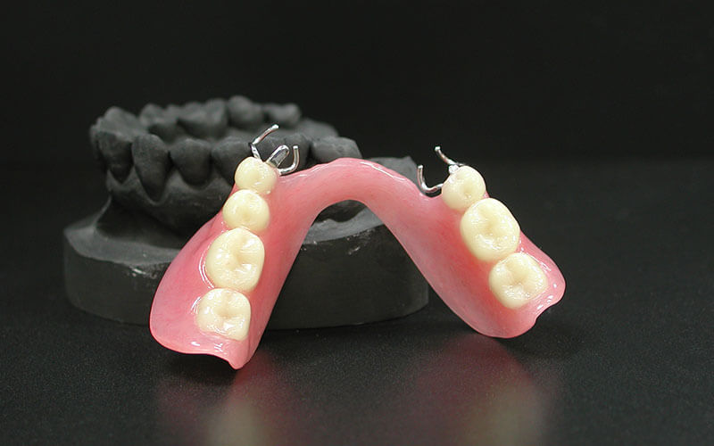 バネ（鉤、クラスプ）式入れ歯