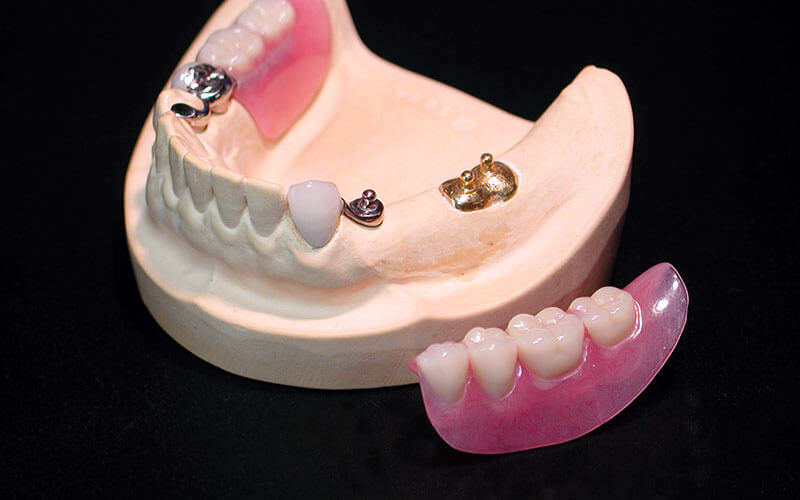 アタッチメント義歯