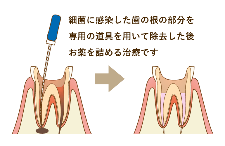 根管治療