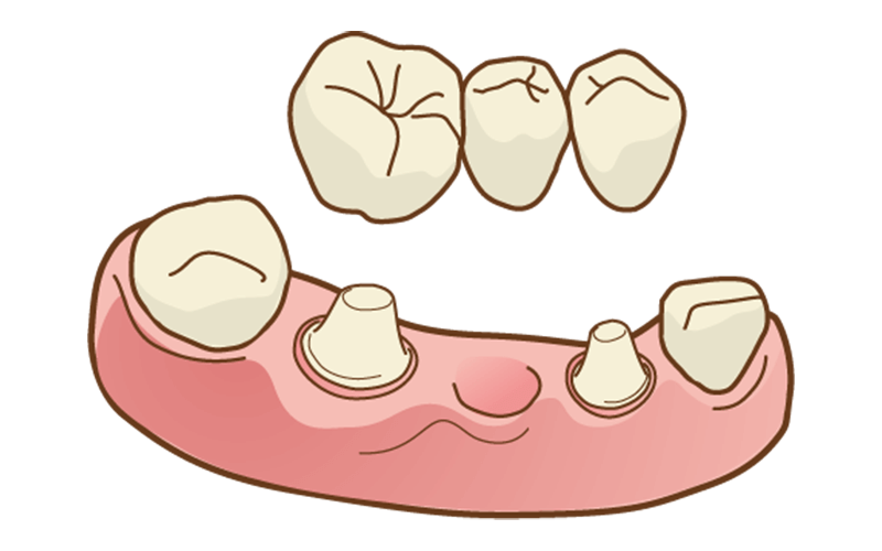 ブリッジ治療