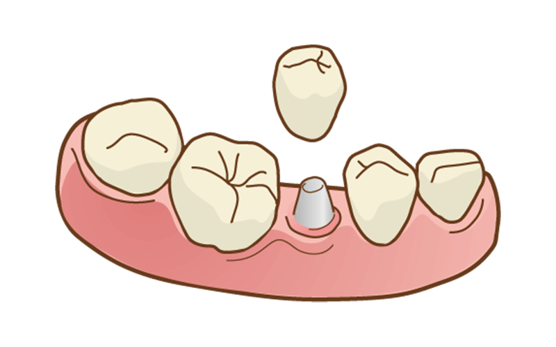 インプラント治療