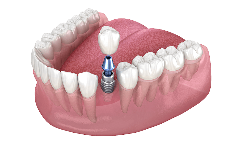 インプラント手術法