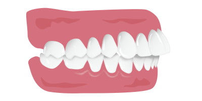 上顎前突（出っ歯）