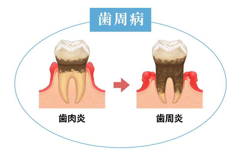 歯肉炎・歯周病
