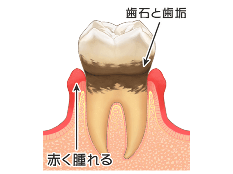 歯周病
