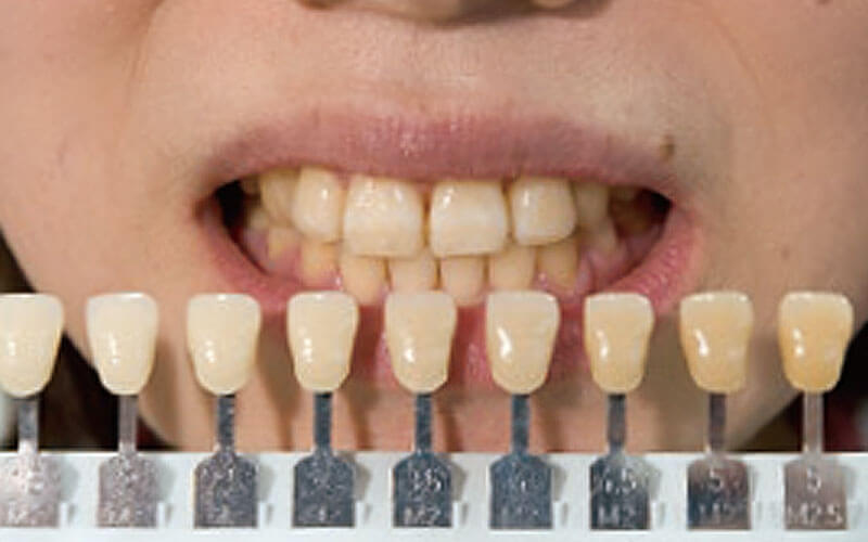 インフォームドコンセント