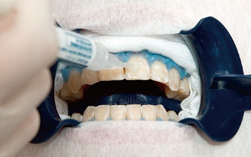 ホワイトニングジェルの塗布