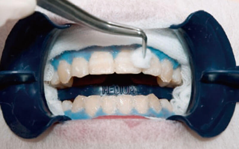 ホワイトニングジェルの除去